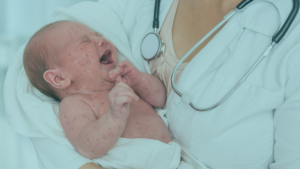 Read more about the article Measles Symptoms in Babies