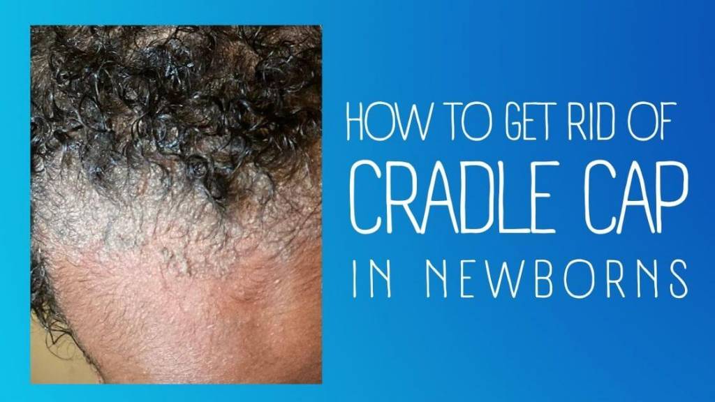 How to get rid of cradle cap in newborns
