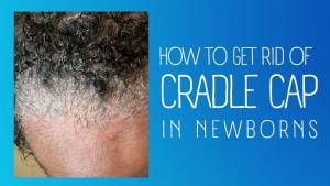 Read more about the article How To Get Rid of Cradle Cap in Newborns